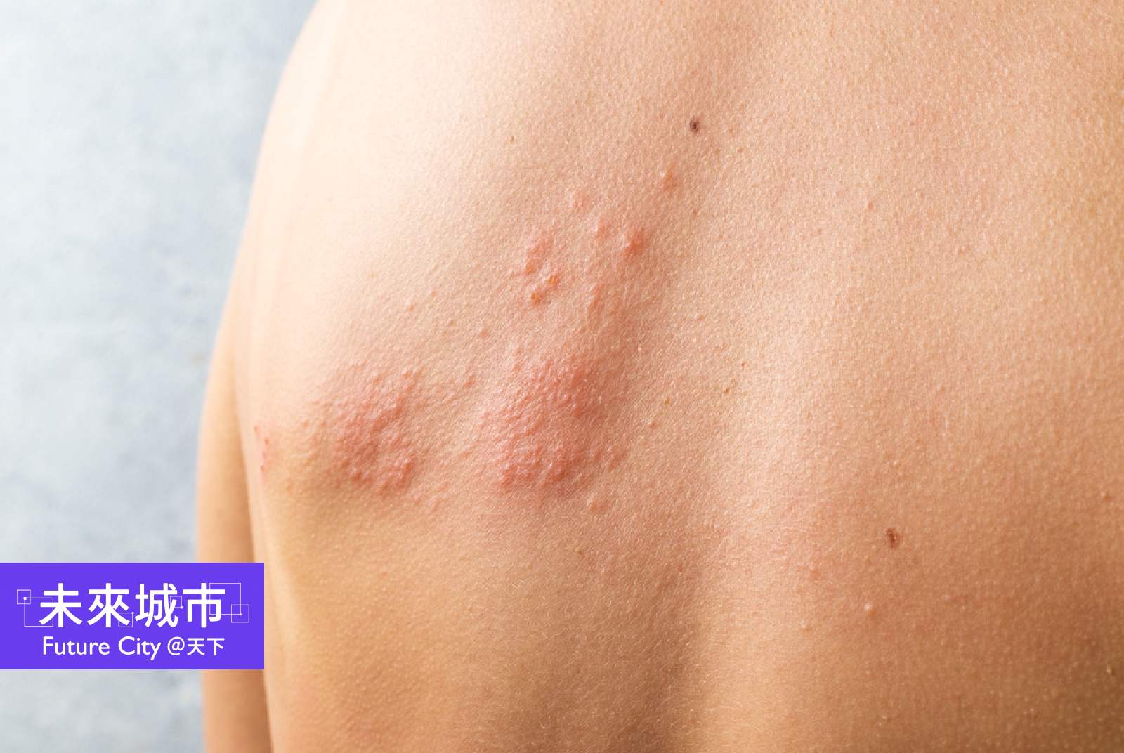 沉睡的病毒：解密帶狀疱疹，維持健康生活、注射疫苗都重要