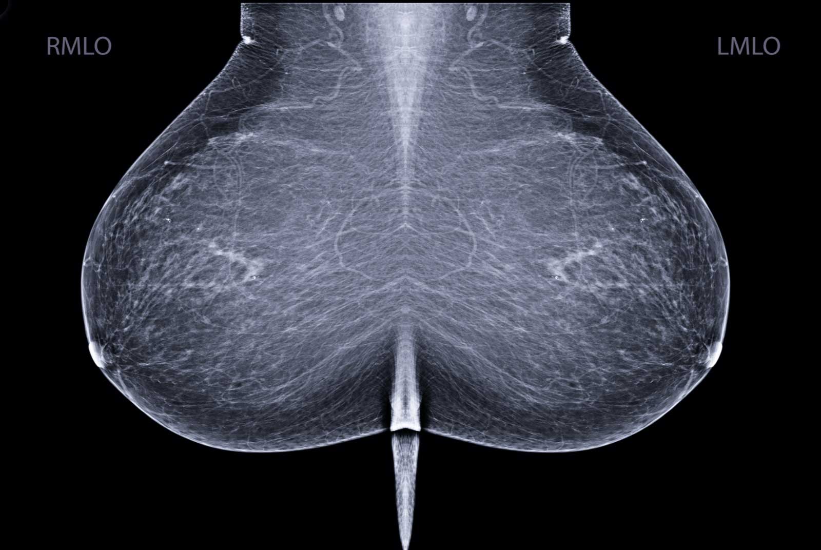 讓AI分析乳房攝影能捕捉細微變化，協助乳癌的早期診斷。